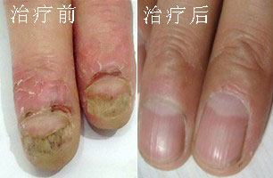 灰指甲