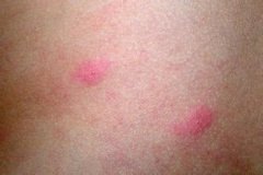 湿疹会引起哪些常见的危害